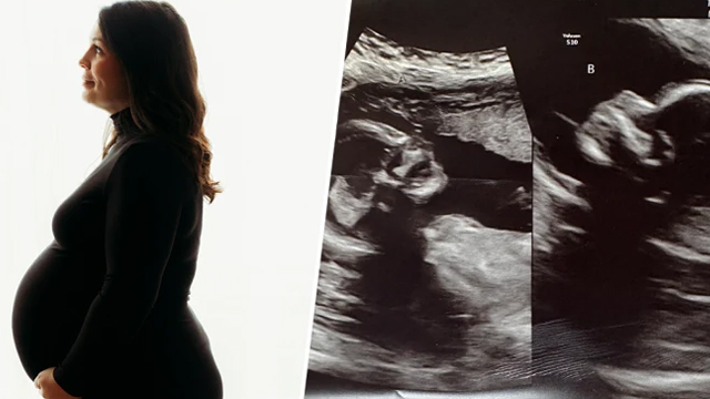 SEGRE: “Donna dell’Alabama nata con due uteri aspetta un bambino in entrambi “