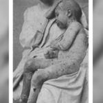 SILVANA DE MARI: “La vera storia del vaiolo e della sua vaccinazione”